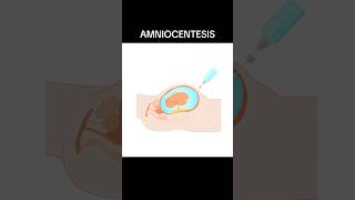 AMNIOCENTESIS amniocentesis  WHAT IS AMNIOCENTESIS shortsviraltrending [upl. by Molini133]