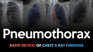 Pneumothorax Rapid Review of Chest Xrays [upl. by Nanyk]