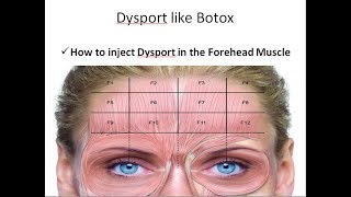 How to inject Dysport in the Forehead Muscle [upl. by Pacificia]