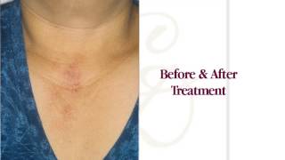 How To Remove A Birthmark  Crutchfield Dermatology [upl. by Massey]