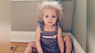 What Is Causing Child’s Uncombable Hair Syndrome [upl. by Knox]