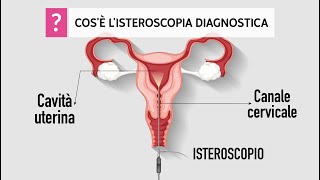 Isteroscopia diagnostica cos’è quando è indicata e come si esegue [upl. by Yetti]