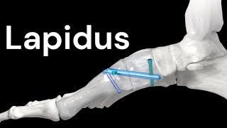 Solutions for Lapidus Bunionectomy Surgery [upl. by Wilfrid990]