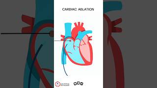 Cardiac Ablation cardiology [upl. by Nirat]