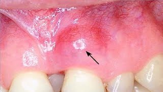 how to get rid of gum abscess home treatment [upl. by Nilo79]