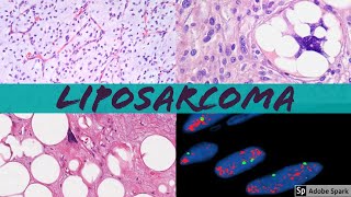 Liposarcoma 101 Everything a Pathologist Needs to Know [upl. by Loomis]