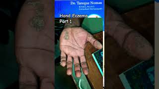 Hand Eczema skinproblems eczema homeopathy itching skinproblems autoimmunedisease khujli [upl. by Biegel]