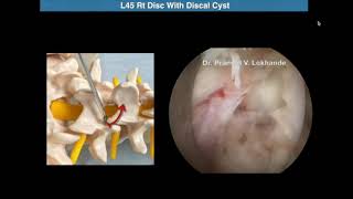 Full Endoscopic Interlaminar Discectomy  Dr Pramod Lokhande [upl. by Ennairrek]