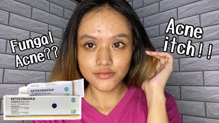 I tried to use ketoconazole cream for my small acne⎮English⎮66 [upl. by Waite295]