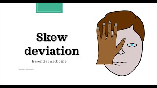 Skew deviation test  Test of Skew Essential medicine [upl. by Aicak]