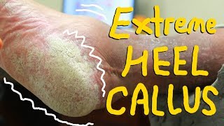 Extreme heel Psoriasis removal MY FIRST MISTAKE [upl. by Caniff]