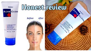 which is best face wash for acne  Mistine acne clear plus foaming face wash honest review [upl. by Ahsemad]