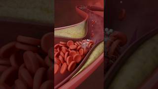 Lower Limb Angioplasty and Stenting3D Medical Animation LowerLimbStentingShorts LowerLimbviral [upl. by Toole]