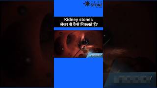 Kidney stones Treatment  RIRS  Laser kidney stone treatment shorts [upl. by Budde266]