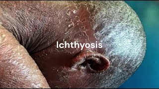 What is Ichthyosis  Ichthyosis Treatment in Homeopathy [upl. by Nibbs]