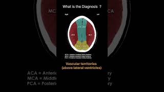 Vascular territories  above lateral ventricles CT Brain Anatomy Quiz 32radiologychannel007 [upl. by Aihsekyw]