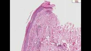 Histopathology SkinLeukocytoclastic vasculitis [upl. by Can]