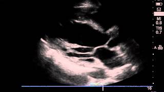 pericarditis Septal bounce [upl. by Saltzman]