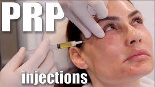 PRP Injections to Face and Neck Blood Facial [upl. by Nosraep]