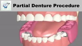 Removable Partial Dentures Steps [upl. by Rusell48]