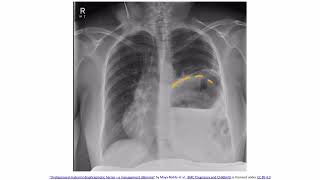 Chest Trauma Pulmonary Contusion amp Diaphragmatic Rupture [upl. by Heater]