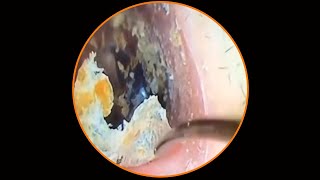 Satisfying Ear Wax Removal With Dr Zhao Video 87 [upl. by Hoffert]