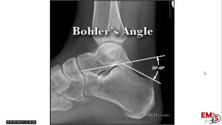 Calcaneal Fractures [upl. by Corney]