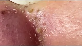 TOP OF BLACKHEADS REMOVAL FROM THE NOSE 😨 relaxing blackheads [upl. by Yseulta]