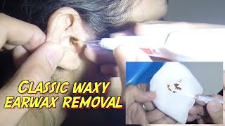 Classic Waxy Earwax Removal [upl. by Camroc]