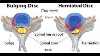 Disc Herniation vs Disc Bulge [upl. by Eiramanel]