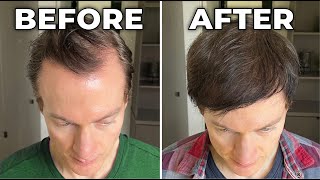 How I Reversed My Hair Loss  Greying [upl. by Aisiram]