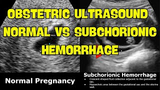 Hemorrhoids Lecture for USMLE [upl. by Oiretule792]