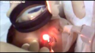 Laser Treatment of Retinopathy of prematurity ROP [upl. by Alyce]