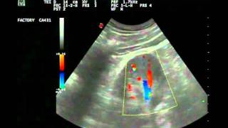 Kidney Ultrasound  Colour Comet Tail Artefact and kidney stones [upl. by Gasser]