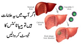 hepatitis Ki alamat ka khayal rakhe [upl. by Melburn]