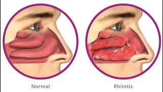 Simple Athome Remedies For Allergic Rhinitis [upl. by Atsyrt]