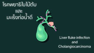 โรคพยาธิใบไม้ตับและมะเร็งท่อน้ำดี Bile duct cancer  Opisthorchiasis and Cholangiocarcinoma [upl. by Einhoj]