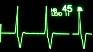 Accelerated Ventricular Rhythm AVR [upl. by Melosa]