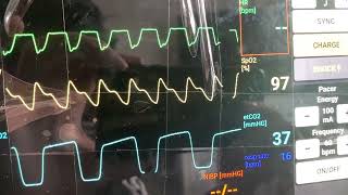 Pulseless Ventricular Rhythm [upl. by Matelda958]