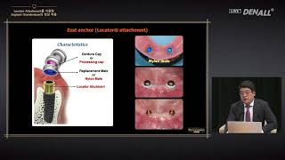 PROSTHODONTICS Clinical Application of Implant Overdenture Using Locator Attachment [upl. by Nigem553]