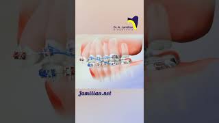 Upper Jaw Retraction Using First Molar Extraction bracs dentist orthodontics smile extraction [upl. by Earal]