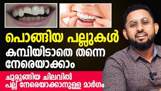 പൊങ്ങിയ പല്ലുകൾ കമ്പിയിടാതെ തന്നെ നേരെയാക്കാം  Clear Aligners Malayalam  Dr Varun Nambiar [upl. by Mcdougall]