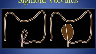 Cecal and sigmoid volvulus version 1 0 edit [upl. by Gudren937]