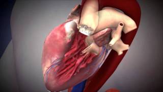 NUHCS  Transcatheter Aortic Valve Implantation TAVI [upl. by Adamsun]