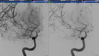 Intraarterial Treatment of Intracranial Vasospasm Nimodipine [upl. by Alegnave40]