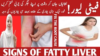 Get Rid Of Fatty Liver Without Medicine Can Fasting Help Reverse Fatty LiverListen Your Body [upl. by Notpmah152]