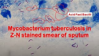 Mycobacterium tuberculosis in ZiehlNeelsen stained smear of Sputum [upl. by Jermyn]