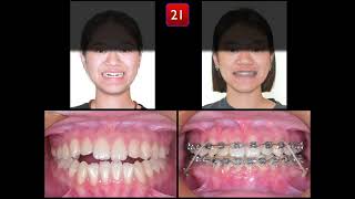 Solving Class III Malocclusion with Anterior Openbite by Damon Q2｜【Chris Chang Ortho】CC801 [upl. by Nial553]