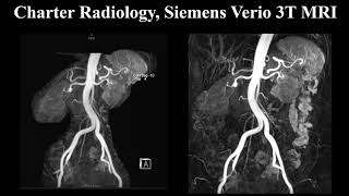 Renal MRA [upl. by Yantruoc805]