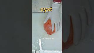 Ovarian cyst specimen [upl. by Ataliah237]